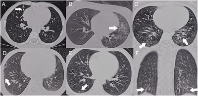 Pulmonary Involvement in Children With Systemic Lupus Erythematosus